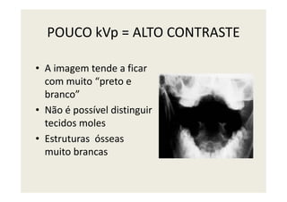 POUCO kVp = ALTO CONTRASTE
• A imagem tende a ficar
com muito “preto e
branco”
• Não é possível distinguir
tecidos moles
• Estruturas ósseas
muito brancas
 