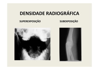 DENSIDADE RADIOGRÁFICA
SUPEREXPOSIÇÃO SUBEXPOSIÇÃO
 
