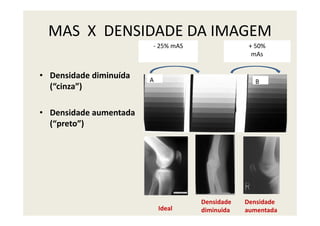 • Densidade diminuída
(“cinza”)
• Densidade aumentada
MAS X DENSIDADE DA IMAGEM
A B
- 25% mAS + 50%
mAs
• Densidade aumentada
(“preto”)
Ideal
Densidade
diminuida
Densidade
aumentada
 