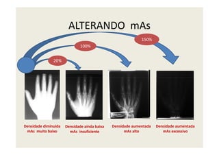 ALTERANDO mAs
20%
100%
150%
Densidade diminuida
mAs muito baixo
Densidade ainda baixa
mAs insuficiente
Densidade aumentada
mAs alto
Densidade aumentada
mAs excessivo
 