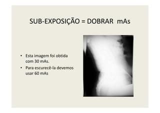 SUB-EXPOSIÇÃO = DOBRAR mAs
• Esta imagem foi obtida• Esta imagem foi obtida
com 30 mAs.
• Para escurecê-la devemos
usar 60 mAs
 