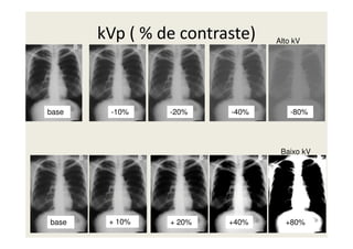 kVp ( % de contraste)
base -10% -80%-40%-20%
Alto kV
base + 10% +40%+ 20% +80%
Baixo kV
 