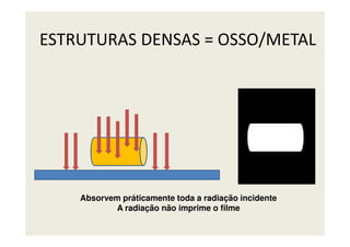 ESTRUTURAS DENSAS = OSSO/METAL
Absorvem práticamente toda a radiação incidente
A radiação não imprime o filme
 