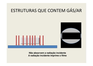 ESTRUTURAS QUE CONTEM GÁS/AR
Não absorvem a radiação incidente
A radiação incidente imprime o filme
 