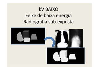 kV BAIXO
Feixe de baixa energia
Radiografia sub-exposta
 