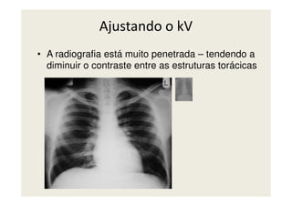 Ajustando o kV
• A radiografia está muito penetrada – tendendo a
diminuir o contraste entre as estruturas torácicas
 