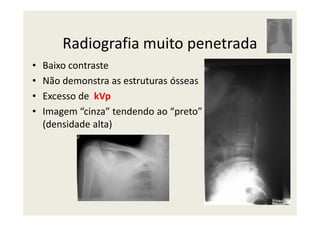 Radiografia muito penetrada
• Baixo contraste
• Não demonstra as estruturas ósseas
• Excesso de kVp
• Imagem “cinza” tendendo ao “preto”• Imagem “cinza” tendendo ao “preto”
(densidade alta)
 