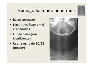 Radiografia muito penetrada
• Baixo contraste
• Estruturas ósseas mal
visibilizadas
• Fundo cinza (mA• Fundo cinza (mA
insuficiente)
• Usar a regra do 50/15
(mA/kV)
 