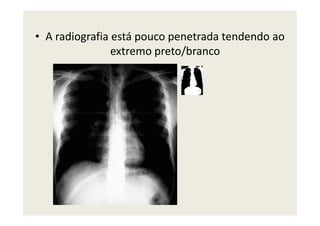 • A radiografia está pouco penetrada tendendo ao
extremo preto/branco
 