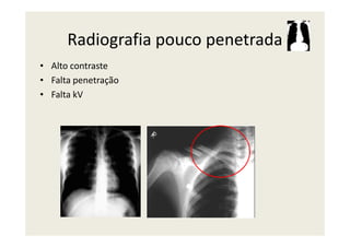 Radiografia pouco penetrada
• Alto contraste
• Falta penetração
• Falta kV
 