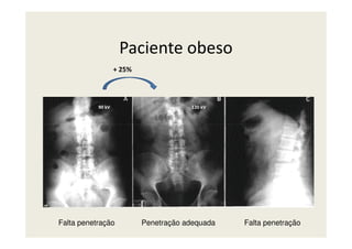 Paciente obeso
90 kV 120 kV
+ 25%
Falta penetração Falta penetraçãoPenetração adequada
 