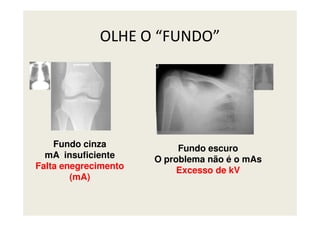 OLHE O “FUNDO”
Fundo cinza
mA insuficiente
Falta enegrecimento
(mA)
Fundo escuro
O problema não é o mAs
Excesso de kV
 