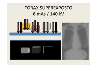 TÓRAX SUPEREXPOSTO
6 mAs / 140 kV
 