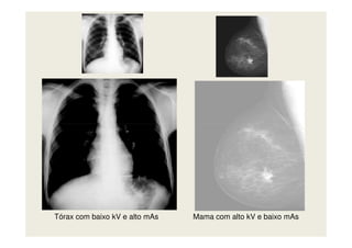 Tórax com baixo kV e alto mAs Mama com alto kV e baixo mAs
 