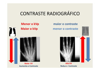 CONTRASTE RADIOGRÁFICO
Menor o kVp maior o contraste
Maior o kVp menor o contraste
Alto kV
Reduz o Contraste
Baixo kV
Aumenta o Contraste
 