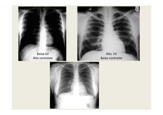 Baixo kV
Alto contraste
Alto kV
Baixo contrasteAlto contraste Baixo contraste
 