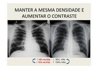 MANTER A MESMA DENSIDADE E
AUMENTAR O CONTRASTE
15% no kVp - 50% mAs
15% no kVp - 100% mAs.
 