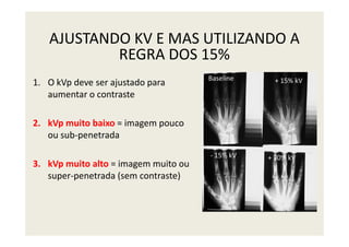 AJUSTANDO KV E MAS UTILIZANDO A
REGRA DOS 15%
1. O kVp deve ser ajustado para
aumentar o contraste
2. kVp muito baixo = imagem pouco
Baseline + 15% kV
2. kVp muito baixo = imagem pouco
ou sub-penetrada
3. kVp muito alto = imagem muito ou
super-penetrada (sem contraste)
- 15% kV + 30% kV
 