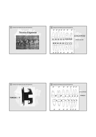 CONCEITOS BÁSICOS EM ORTODONTIA
Técnica Edgewise
CONCEITOS BÁSICOS EM ORTODONTIA
EDGEWISE
ANGULAÇÃO
CONCEITOS BÁSICOS EM ORTODONTIA
TORQUE = 0
CONCEITOS BÁSICOS EM ORTODONTIA
EDGEWISE
TORQUE
 
