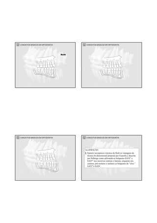 CONCEITOS BÁSICOS EM ORTODONTIA
Roth
CONCEITOS BÁSICOS EM ORTODONTIA
CONCEITOS BÁSICOS EM ORTODONTIA CONCEITOS BÁSICOS EM ORTODONTIA
3a.GERAÇÃO
§ Epstein incorporou à técnica de Roth as vantagens da
técnica bi-dimensional proposta por Gianelly e descrita
por Nóbrega como utilizando-se bráquetes 0,018” x
0,025” nos incisivos centrais e laterais, enquanto nos
caninos, pré-molares e molares os bráquetes de “slots”
0,022”x 0,028’.
 