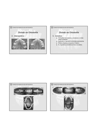 CONCEITOS BÁSICOS EM ORTODONTIA
2. Interceptativa:
Divisão da Ortodontia
CONCEITOS BÁSICOS EM ORTODONTIA
3. Corretiva:
Correções mais severas, complexas e muitas
vezes mutilantes.
Realizada no período de dentição permanente.
Efeitos ortopédicos bastante limitados
Ex: Aparelhos ortodônticos fixos completos.
Divisão da Ortodontia
CONCEITOS BÁSICOS EM ORTODONTIA CONCEITOS BÁSICOS EM ORTODONTIA
 
