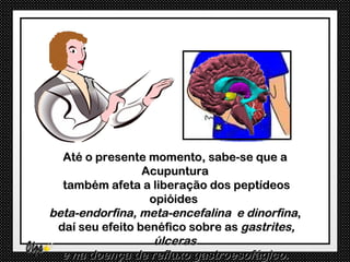 Até o presente momento, sabe-se que a
                 Acupuntura
  também afeta a liberação dos peptídeos
                  opióides
beta-endorfina, meta-encefalina e dinorfina,
 daí seu efeito benéfico sobre as gastrites,
                   úlceras
  e na doença de refluxo gastroesofágico.
 