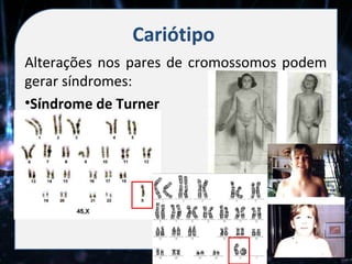 Cariótipo
Alterações nos pares de cromossomos podem
gerar síndromes:
•Síndrome de Turner
 