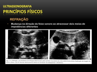 •  Mudança na direção do feixe sonoro ao atravessar dois meios de
impedâncias diferentes
 
