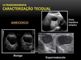 Bexiga
Cisto
hepático
simples
Espermatocele
 