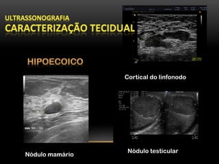 Cortical do linfonodo
Nódulo mamário
Nódulo testicular
 
