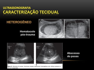 Hematocele
pós-trauma
Abscesso
do psoas
 