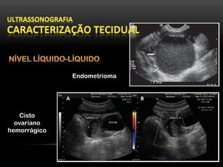 Endometrioma
Cisto
ovariano
hemorrágico
 