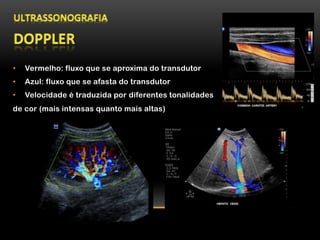 •  Vermelho: fluxo que se aproxima do transdutor
•  Azul: fluxo que se afasta do transdutor
•  Velocidade é traduzida por diferentes tonalidades
de cor (mais intensas quanto mais altas)
 
