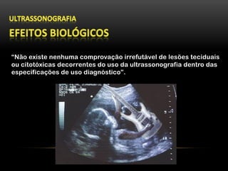 “Não existe nenhuma comprovação irrefutável de lesões teciduais
ou citotóxicas decorrentes do uso da ultrassonografia dentro das
especificações de uso diagnóstico”.
 
