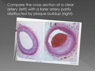 Compare thecrosssection of a clearartery (left) with a llarerarterypartlyobstructedby plaque buildup (right).