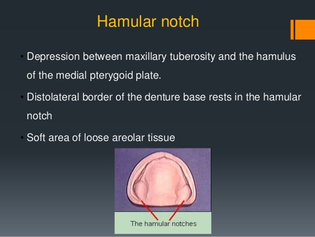 hamular notch