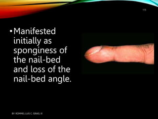 •Manifested
initially as
sponginess of
the nail-bed
and loss of the
nail-bed angle.
BY: ROMMEL LUIS C. ISRAEL III
115
 