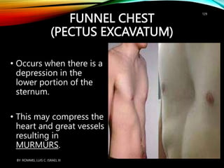 FUNNEL CHEST
(PECTUS EXCAVATUM)
• Occurs when there is a
depression in the
lower portion of the
sternum.
• This may compress the
heart and great vessels
resulting in
MURMURS.
BY: ROMMEL LUIS C. ISRAEL III
129
 