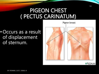 PIGEON CHEST
( PECTUS CARINATUM)
•Occurs as a result
of displacement
of sternum.
BY: ROMMEL LUIS C. ISRAEL III
132
 