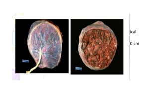 • The placenta is attached to the uterine wall and establishes
connection between the mother and fetus through the umbilical
cord.
• The placenta at term is a circular disc with a diameter of 15-20 cm
and thickness of about 2.5 cm at its center.
• Its spongy and weighs approximately 500 gm.
• It has two surfaces, fetal(smooth) and maternal(rough).
 