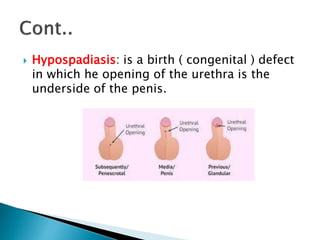  Hypospadiasis: is a birth ( congenital ) defect
in which he opening of the urethra is the
underside of the penis.
 