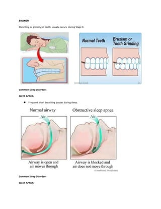 BRUXISM
Clenching or grinding of teeth, usually occurs during Stage II.
Common Sleep Disorders
SLEEP APNEA:
 Frequent short breathing pauses during sleep.
Common Sleep Disorders
SLEEP APNEA:
 