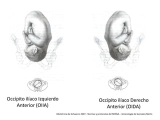 Occípito ilíaco Izquierdo
Anterior (OIIA)

Occípito ilíaco Derecho
Anterior (OIDA)

Obstetricia de Schwarcz 2007 - Normas y protocolos del MINSA. - Ginecología de Gonzales Merlo

 