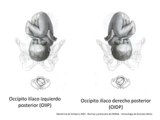 Occípito iIíaco izquierdo
posterior (OIIP)

Occípito ilíaco derecho posterior
(OIDP)

Obstetricia de Schwarcz 2007 - Normas y protocolos del MINSA. - Ginecología de Gonzales Merlo

 