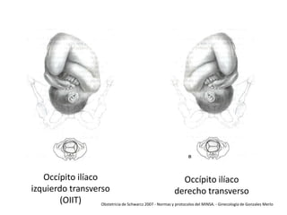 Occípito ilíaco
Occípito ilíaco
izquierdo transverso
derecho transverso
(OIIT)
Obstetricia de Schwarcz 2007 - Normas y protocolos del MINSA. - Ginecología de Gonzales Merlo

 