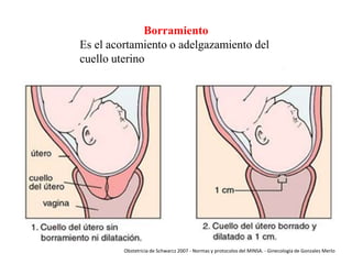 Borramiento
Es el acortamiento o adelgazamiento del
cuello uterino

Obstetricia de Schwarcz 2007 - Normas y protocolos del MINSA. - Ginecología de Gonzales Merlo

 