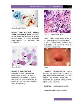 CONCEPTOS BÁSICOS PARA LA CITOLOGÍA CERVICAL
Julio de
2009
9
CELULAS FENESTRADAS
CELULAS CLAVE/ CLUE CELL. TAMBIEN
LLAMADOS DUNAS DE ARENA. DEPOSITOS
DE BACTERIAS CON ASPECTO DE AZUCAR
MOLIDO SOBRE LAS CELULAS MADURAS,
CARACTERISTICO EN INFECCION POR
GARDNERELLA.
CELULAS CLAVE
CELULAS EN ANILLO DE SELLO
PRESENCIA DE UNA VACUOLA TAN
GRANDE QUE SUSTITUYE A TODO EL
CITOPLASMA Y COMPRIME EL NUCLEO
QUE PRESENTA RASGOS MALIGNOS. SE
OBSERVAN EN LOS ADENOCARCINOMAS
POCO DIFERENCIADOS.
CELULAS EN ANILLO DE SELLO
CERVIX / CERVIX LA PARTE BAJA, ESTRECHA
DEL ÚTERO (MATRIZ) LOCALIZADA ENTRE LA
VEJIGA Y EL RECTO. FORMA UN CANAL QUE
DESEMBOCA A LA VAGINA, EL CUAL VA
HACIA FUERA DEL CUERPO.
CERVIX
CERVICITIS INFLAMACION DEL CUELLO
UTERINO SIN INVOLUCRAR LA MATRIZ. //
UNA IRRITACIÓN DEL CERVIZ CAUSADA POR
VARIOS ORGANISMOS DIFERENTES. LA
CERVICITIS SE CLASIFICA GENERALMENTE
COMO AGUDA O CRÓNICA.
CIANOFILO COLOR AZUL-VERDOSO.
CILIOCITOFTORIA PERDIDA DE CILIOS.
 