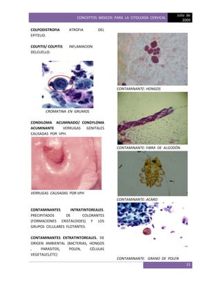 CONCEPTOS BÁSICOS PARA LA CITOLOGÍA CERVICAL
Julio de
2009
11
COLPODISTROFIA ATROFIA DEL
EPITELIO.
COLPITIS/ COLPITIS INFLAMACION
DELCUELLO.
CROMATINA EN GRUMOS
CONDILOMA ACUMINADO/ CONDYLOMA
ACUMINANTE VERRUGAS GENITALES
CAUSADAS POR VPH.
VERRUGAS CAUSADAS POR VPH
CONTAMINANTES INTRATINTOREALES.
PRECIPITADOS DE COLORANTES
(FORMACIONES CRISTALOIDES) Y LOS
GRUPOS CELULARES FLOTANTES.
CONTAMINANTES EXTRATINTOREALES. DE
ORIGEN AMBIENTAL (BACTERIAS, HONGOS
, PARASITOS, POLEN, CÉLULAS
VEGETALES,ETC)
CONTAMINANTE: HONGOS
CONTAMINANTE: FIBRA DE ALGODÓN
CONTAMINANTE: ACARO
CONTAMINANTE: GRANO DE POLEN
 