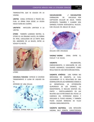 CONCEPTOS BÁSICOS PARA LA CITOLOGÍA CERVICAL
Julio de
2009
29
TRANSDUCTOR, QUE SE COLOCA EN LA
VAGINA.
URETRA CANAL ESTRECHO A TRAVÉS DEL
CUAL LA ORINA PASA DESDE LA VEJIGA
HACIA FUERA DEL CUERPO.
URETRITIS INFECCIÓN LIMITADA A LA
URETRA.
ÚTERO TAMBIÉN LLAMADO MATRIZ, EL
ÚTERO ES UN ÓRGANO HUECO, EN FORMA
DE PERA, LOCALIZADO EN LA PARTE BAJA
DEL ABDOMEN DE LA MUJER, ENTRE LA
VEJIGA Y EL RECTO.
UTERO
VACUOLA / VACUOLE ESPACIO O CAVIDAD
TRANSPARENTE O LLENA DE LIQUIDO EN
EL
INTERIOR DE UNA CELULA.
VACUOLA. ATIPIAS POR DIU
VACUOLIZACION / VACUOLATION
FORMACION DE VACUOLAS POR
CAPTACION CELULAR DE AGUA. TIENEN
DIFERENTES TAMAÑOS Y CUANDO SON
GRANDES PUEDEN DESPLAZAR AL NUCLEO.
EJM. CELULAS EN ANILLO DE SELLO.
CELULAS CON VACUOLAS
VAGINA/ VAGINA CANAL ENTRE EL
CUELLO Y LA VULVA.
VAGINITIS INFLAMACIÓN,
ENROJECIMIENTO, O HINCHAZÓN DE LOS
TEJIDOS VAGINALES; USUALMENTE COMO
RESULTADO DE UNA INFECCIÓN BACTERIAL.
VAGINITIS ATRÓFICA UNA FORMA NO
INFECCIOSA DE VAGINITIS, LA CUAL
USUALMENTE ES EL RESULTADO DE UNA
DISMINUCIÓN EN LAS HORMONAS DEBIDO A
LA MENOPAUSIA, LA EXTIRPACIÓN
QUIRÚRGICA DE LOS OVARIOS, LA
RADIOTERAPIA, O INCLUSO DESPUÉS DEL
PARTO – PARTICULARMENTE EN LAS
MUJERES QUE ESTÁN DANDO DEL PECHO. LA
CARENCIA DEL ESTRÓGENO RESECA Y
ADELGAZA EL TEJIDO VAGINAL, Y TAMBIÉN
PUEDE CAUSAR MANCHAS DE FLUJO
VAGINAL SANGUINOLENTAS.
VAGINITIS BACTERIAL UNA INFECCIÓN
VAGINAL MUY COMÚN, CARACTERIZADA
 