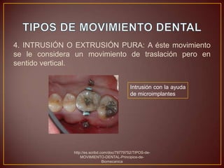 4. INTRUSIÓN O EXTRUSIÓN PURA: A éste movimiento
se le considera un movimiento de traslación pero en
sentido vertical.


                                              Intrusión con la ayuda
                                              de microimplantes




               http://es.scribd.com/doc/79779752/TIPOS-de-
                   MOVIMIENTO-DENTAL-Principios-de-
                                 Biomecanica
 